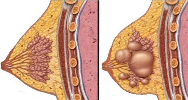 اعراض السرطان الثدي بالصور - اخطر انواع الامراض 9731 5