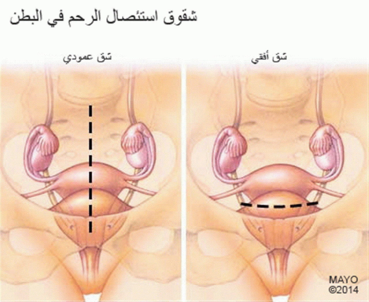 اسباب استئصال الرحم - هذا السبب يؤدى الى استئصال الرحم 9458