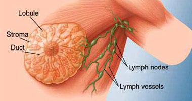 اعراض السرطان الثدي بالصور - اخطر انواع الامراض 9731 2