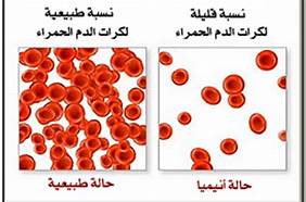 ماهو مرض الانيميا_تعرف عن مرض الانميا 9371 4