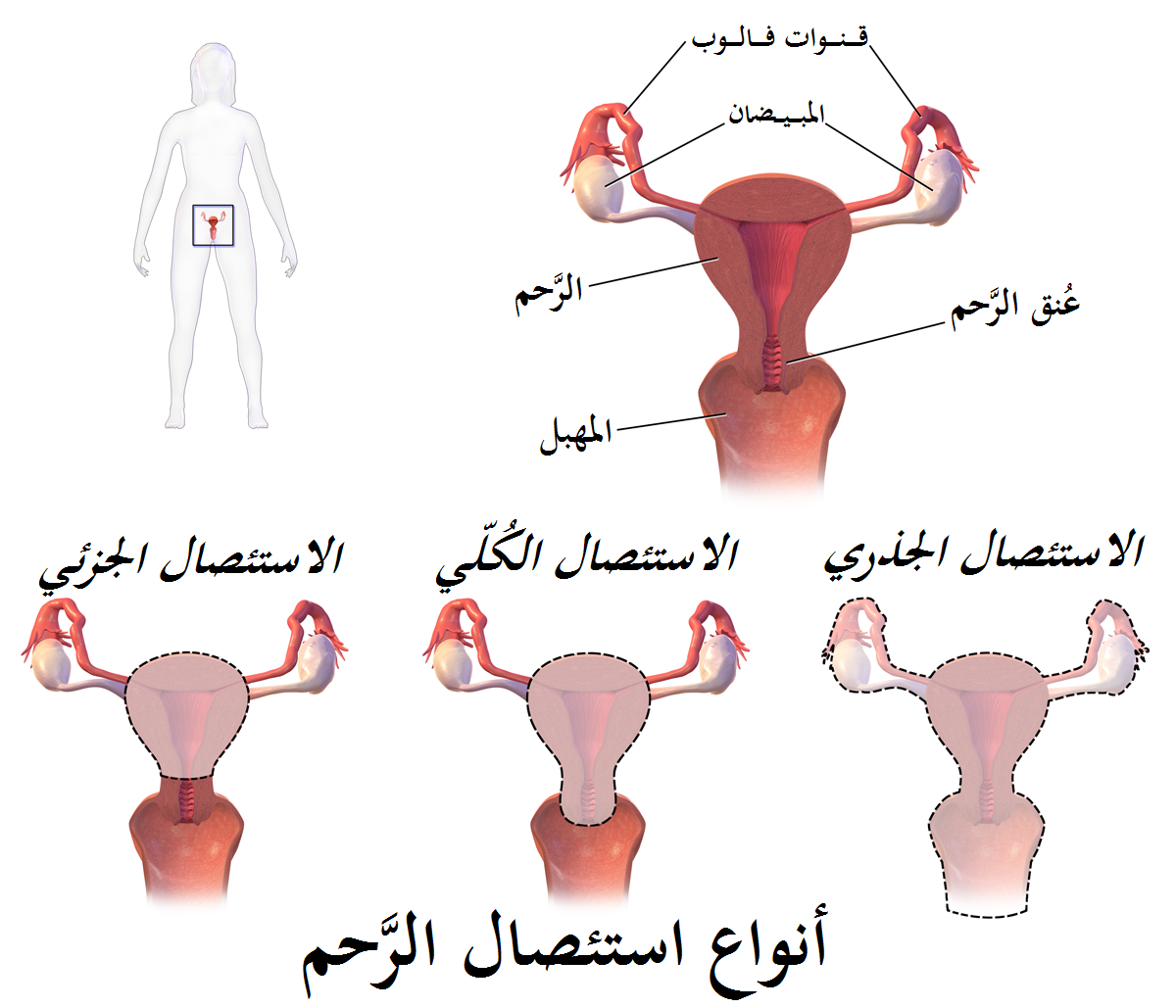 اسباب استئصال الرحم - هذا السبب يؤدى الى استئصال الرحم 9458 4