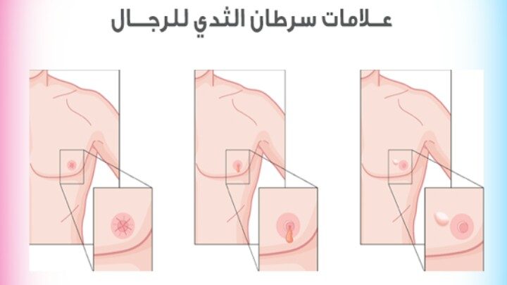 اعراض سرطان الثدي المبكرة جدا بالصور - كيف تكتشفين سرطان الثدي مبكرا 9342 13