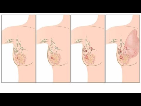 اعراض سرطان الثدي المبكرة جدا بالصور - كيف تكتشفين سرطان الثدي مبكرا 9342 1