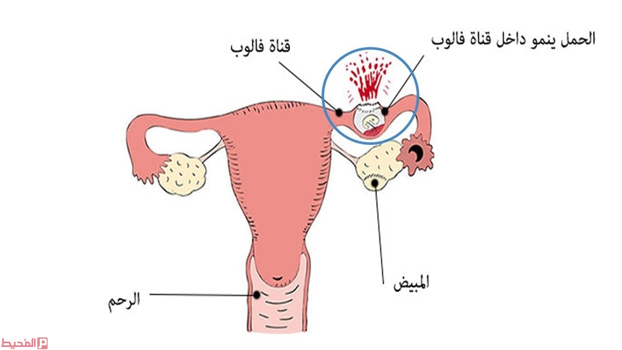 كم يستمر الحمل خارج الرحم , ممكن ميكملش