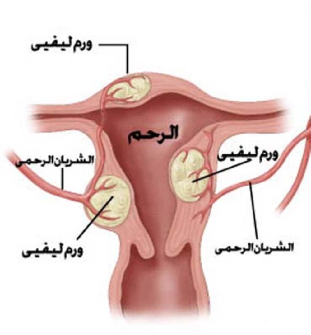 اسباب استئصال الرحم - هذا السبب يؤدى الى استئصال الرحم 9458 2