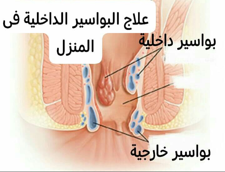 علاج البواسير بالمنزل , ليه حلول كتير