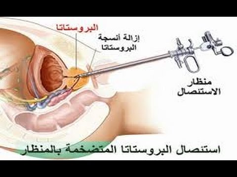 اعراض احتقان البروستاتا الشديد - ما هي الاعراض التي تدلل على احتقان البروستاتا الشديد 9241