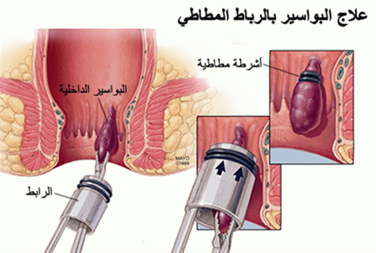 تجربتي في علاج الشرخ- المه بيبقى فظيع 12776