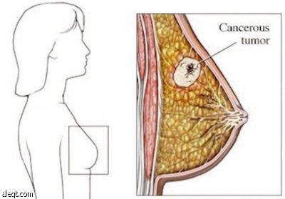 اعراض السرطان الثدي بالصور - اخطر انواع الامراض 9731 10