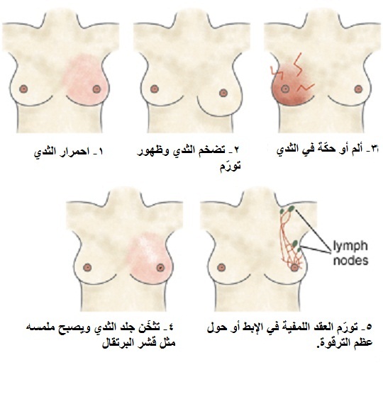 اعراض سرطان الثدي المبكرة جدا بالصور - كيف تكتشفين سرطان الثدي مبكرا 9342 12