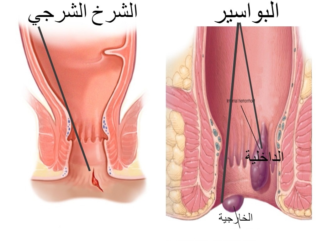 علاج البواسير , العلاج ده هيخلصكم من البواسير نهائيا