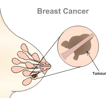 اعراض سرطان الثدي المبكرة جدا بالصور - كيف تكتشفين سرطان الثدي مبكرا 9342