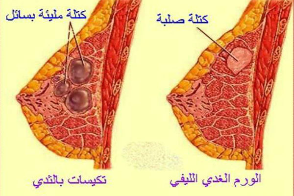 اعراض السرطان الثدي بالصور - اخطر انواع الامراض 9731 6