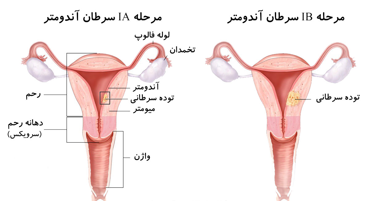 اسباب استئصال الرحم - هذا السبب يؤدى الى استئصال الرحم 9458 4