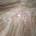8899 3 علاج فطريات الشعر - ما هو افضل علاج لفطريات الشعر اسماء عادل