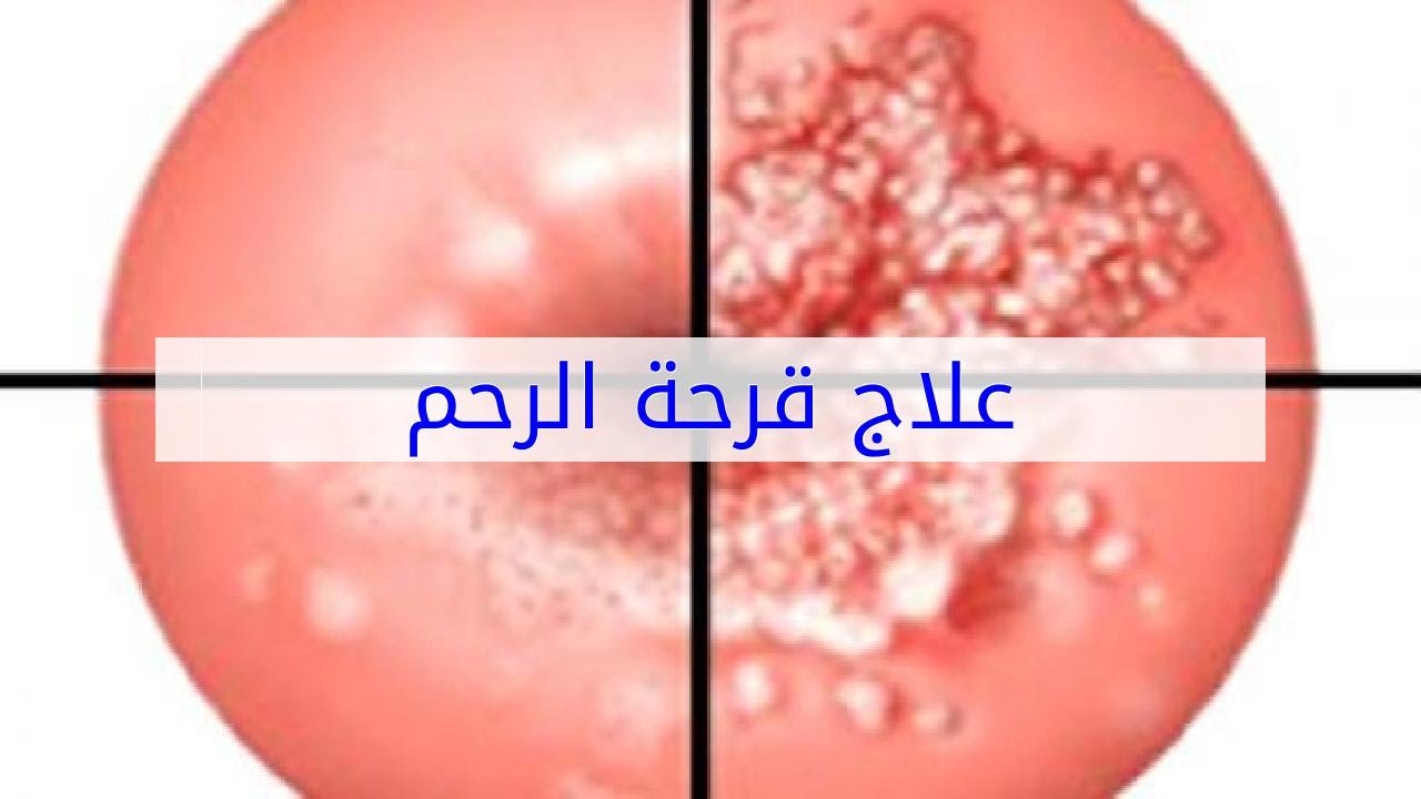 طريقة كي قرحة عنق الرحم بالصور , شوف كوي القرح